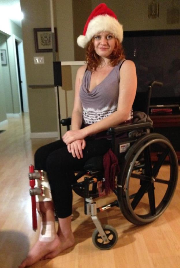 A woman wearing a Santa hat sits in a wheelchair with a large me<em></em>tal bar attached to her leg.